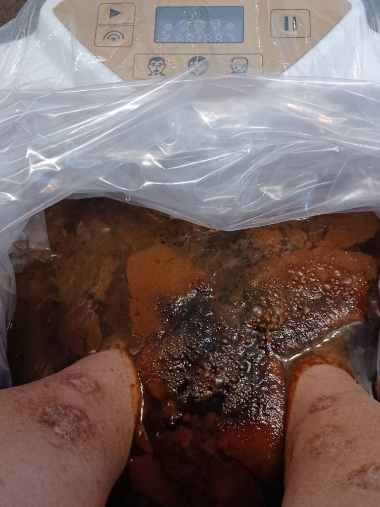 M.Oさんフットデトックス1