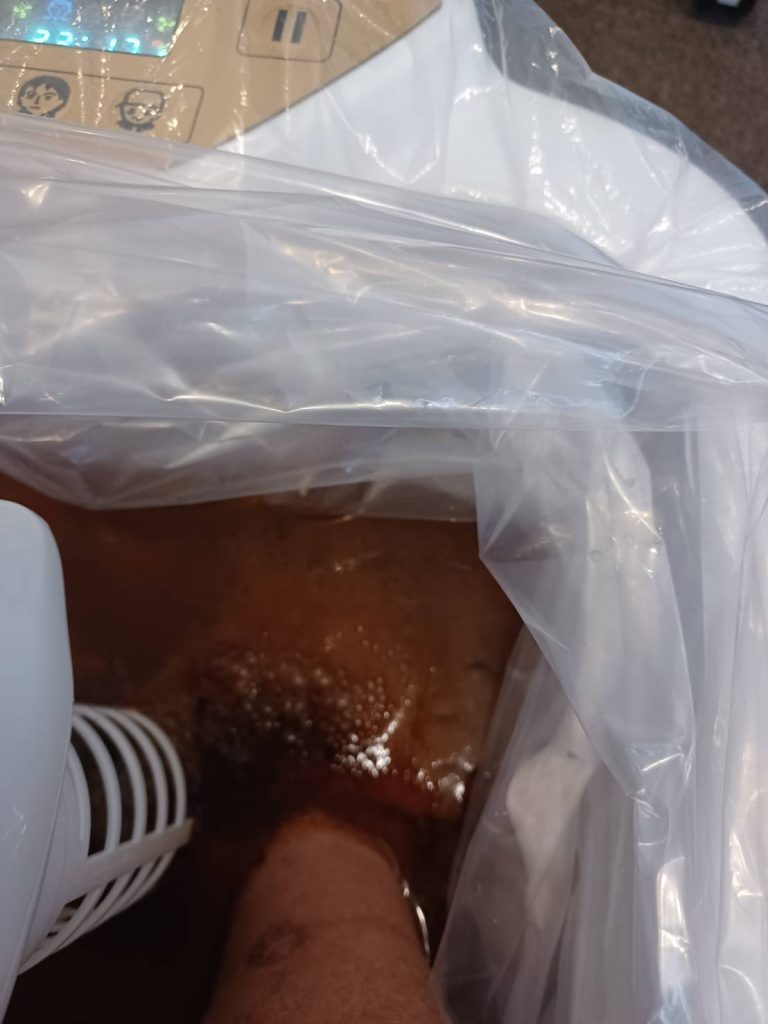 M.Oさんフットデトックス2